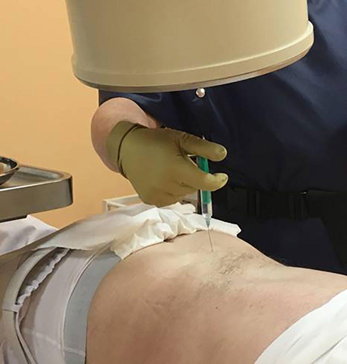 Infiltrationstherapie: Effektive Schmerzlinderung an der Wirbelsäule