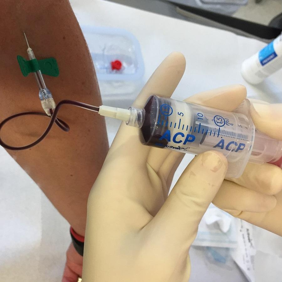 ACP-Therapie: Grundlagen und Funktionsweise der ​körpereigenen Plasmaheilung