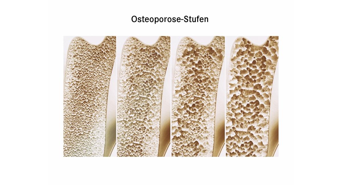 Osteoporose: Frühzeitig verstehen und erkennen – Ein Leitfaden zur Knochendichtemessung
