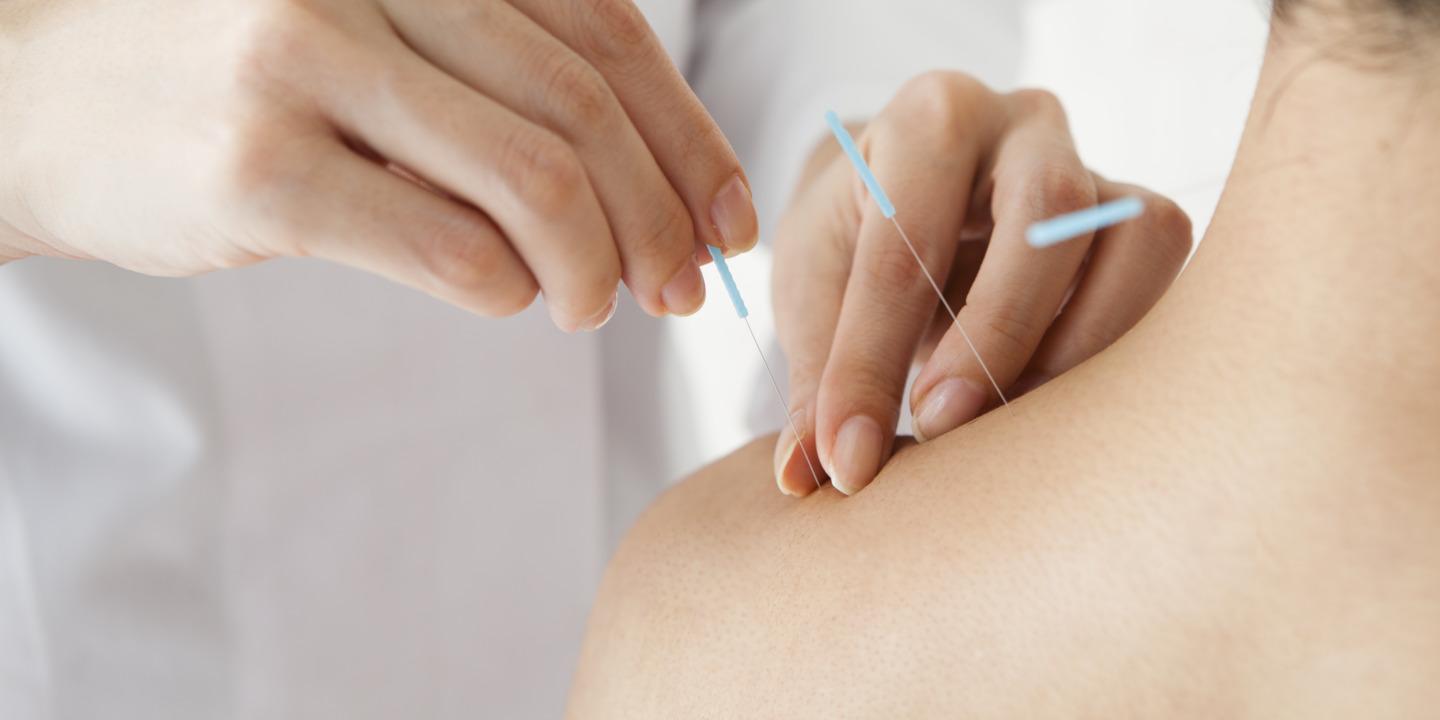Akupunktur als ganzheitliche​ Therapie bei chronischen Rückenschmerzen: Ein Überblick ⁤über die​ Wirksamkeit