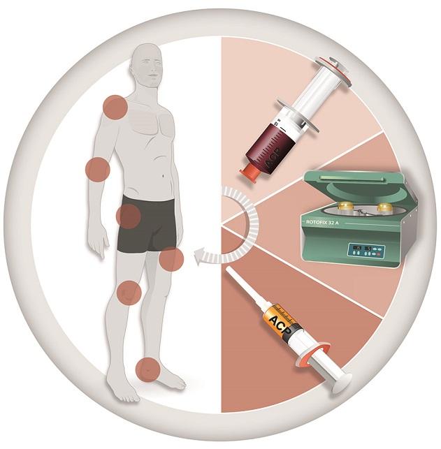 Vorteile der ACP-Therapie: Naturheilkunde trifft moderne Medizin